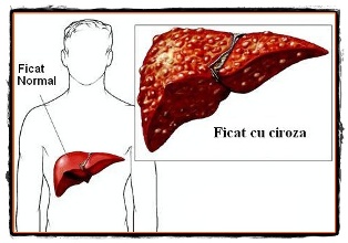 Ciroza hepatica cauze forme si tratament